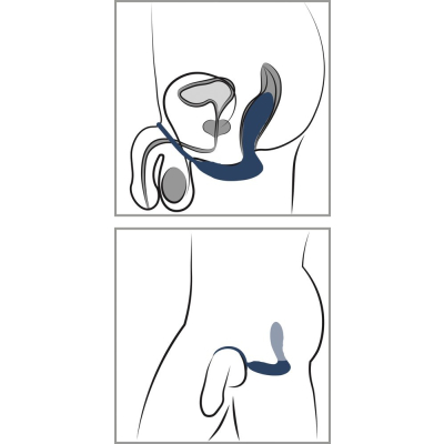 Vibrating Prostate Plug with C